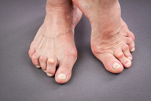 Arthritis Feet
