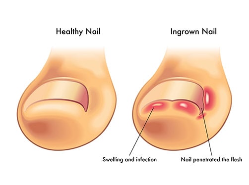 Ingrown Nail