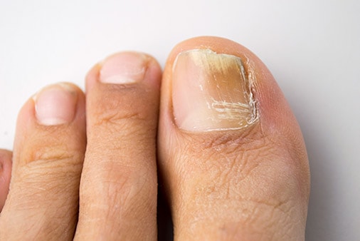 Fungal Nail Infection treatment by Dr.Madhavi Pudi
